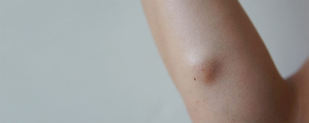 cysts and lumps