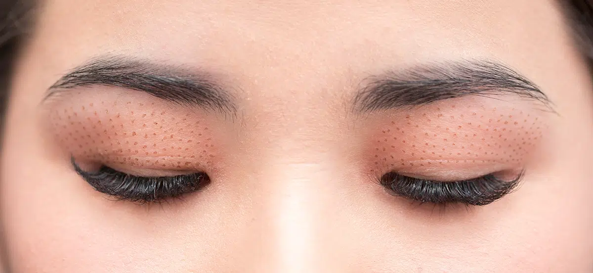 Plasma IQ Non-Surgical Eyelift Treatment CCB