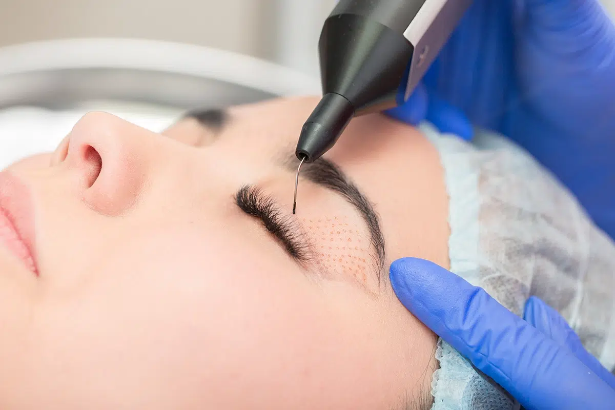 Plasma IQ Non-Surgical Eyelift Treatment