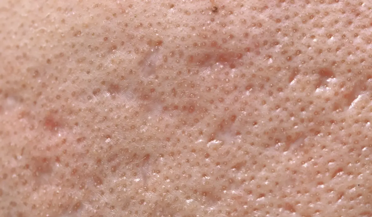 Skin Texture - Scarring