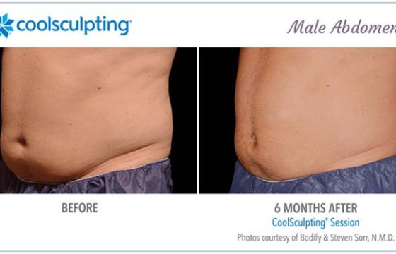 Cool Sculpting
