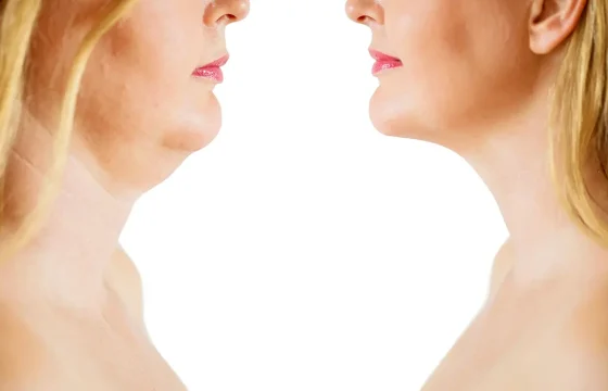 Neck Ageing Neck Lift