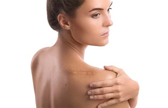Scar Care Advice
