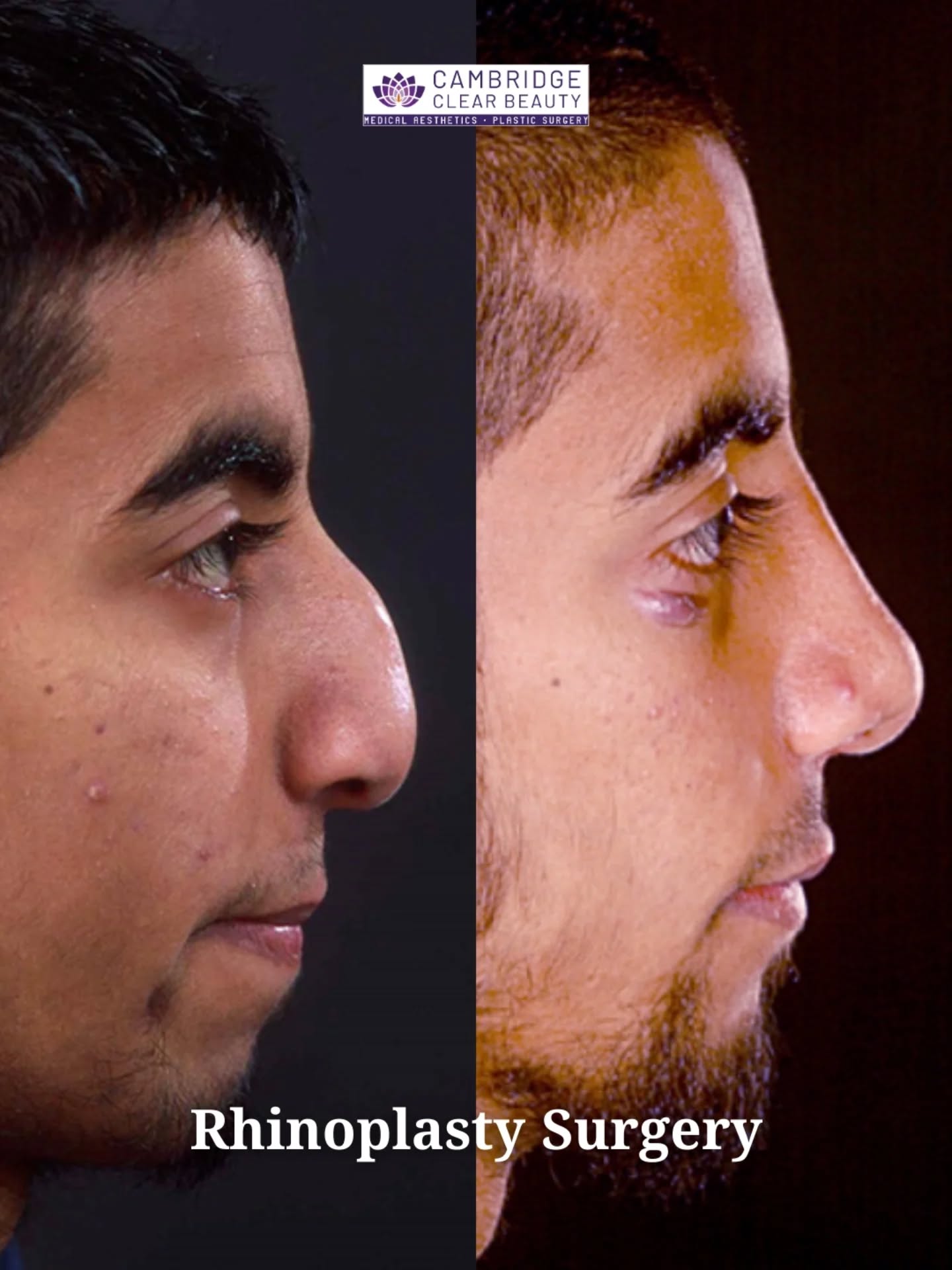 Male rhinoplasty is rarely about making the nose smaller. More often, it is about balance and how the nose sits within the rest of the face.

In this case, the assessment focused on nasal structure, projection, and profile, looking at how the bridge and tip related to the chin, forehead, and overall facial proportions. Skin thickness, bone support, and breathing were all part of the discussion, alongside what level of change felt appropriate for the patient.

The before image shows the nose prior to surgery. The second image was taken months later, once healing had progressed and swelling had largely settled. The profile appears smoother, the nose sits more comfortably within the face, and the changes do not draw attention to themselves.

Before and after photographs show two moments in time, but the most important part of male rhinoplasty happens during consultation. Careful assessment, honest discussion, and understanding limits are what shape the final plan.

If you are considering rhinoplasty and are unsure what would make sense in your own case, a consultation is simply a space to talk through your concerns and understand your options.

📍 Cambridge Clear Beauty, Building G, South Cambs Business Park, Babraham Road, Sawston, CB22 3JH
📱 01223 214 960
💻 www.cambridgeclearbeauty.co.uk

#rhinoplasty #malerhinoplasty #consultantplasticsurgeon #facialassessment #ukplasticsurgery