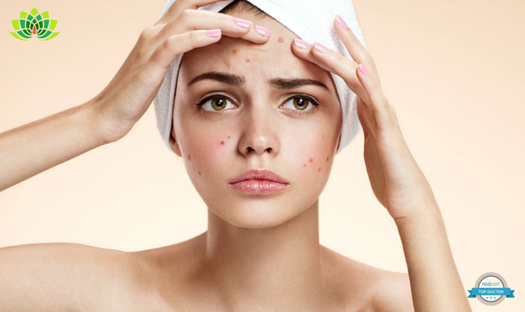 Use Chemical peels that can help with your Adult Acne