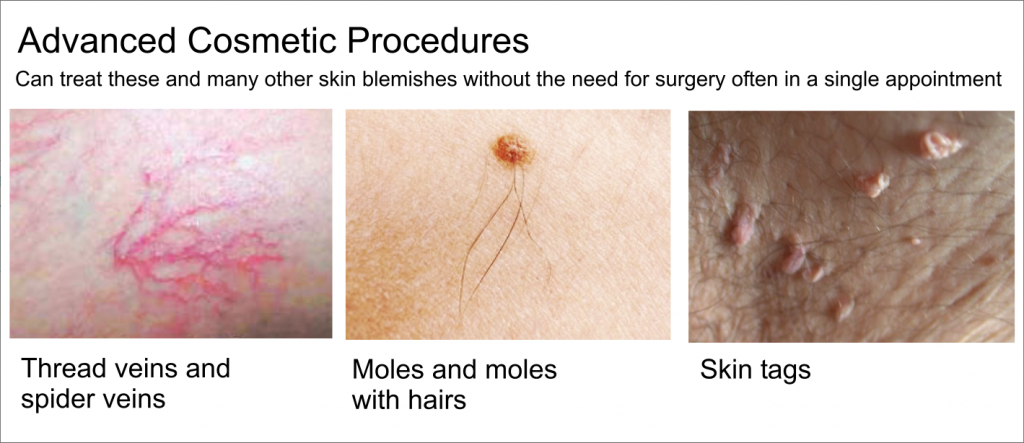 Skin Moles and Blemishes