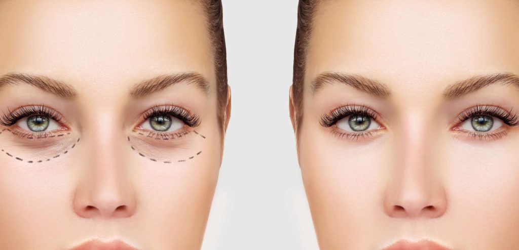 Blepharoplasty - All You Need To Know Cambridge Clear Beauty