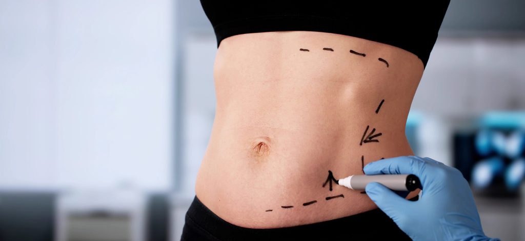 liposuction