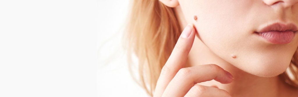 mole removal