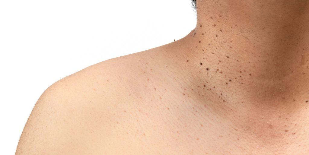 skin tag removal