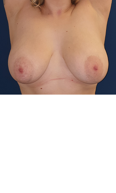 reduction mammaplasty