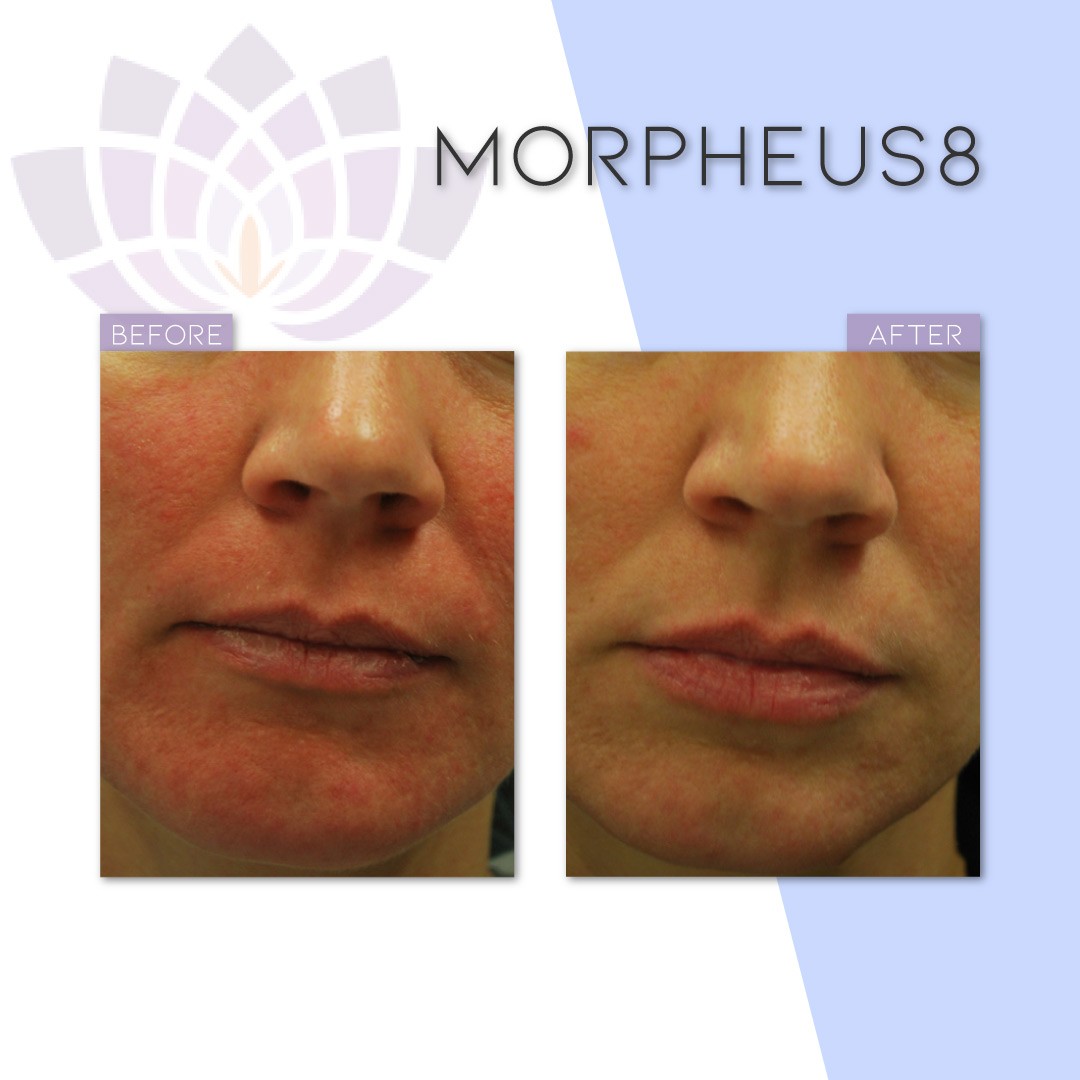 Just look at this #Transformation after our Morpheus8 treatment. It gives you noticeable results after just a few days and improvements will continue for up to three months. The progressive treatment is suitable, safe and effective for all skin types.

#cambridgeclearbeauty #morpheus8 #cambridge 
#wrinkles #antiageing #transformationtuesday
