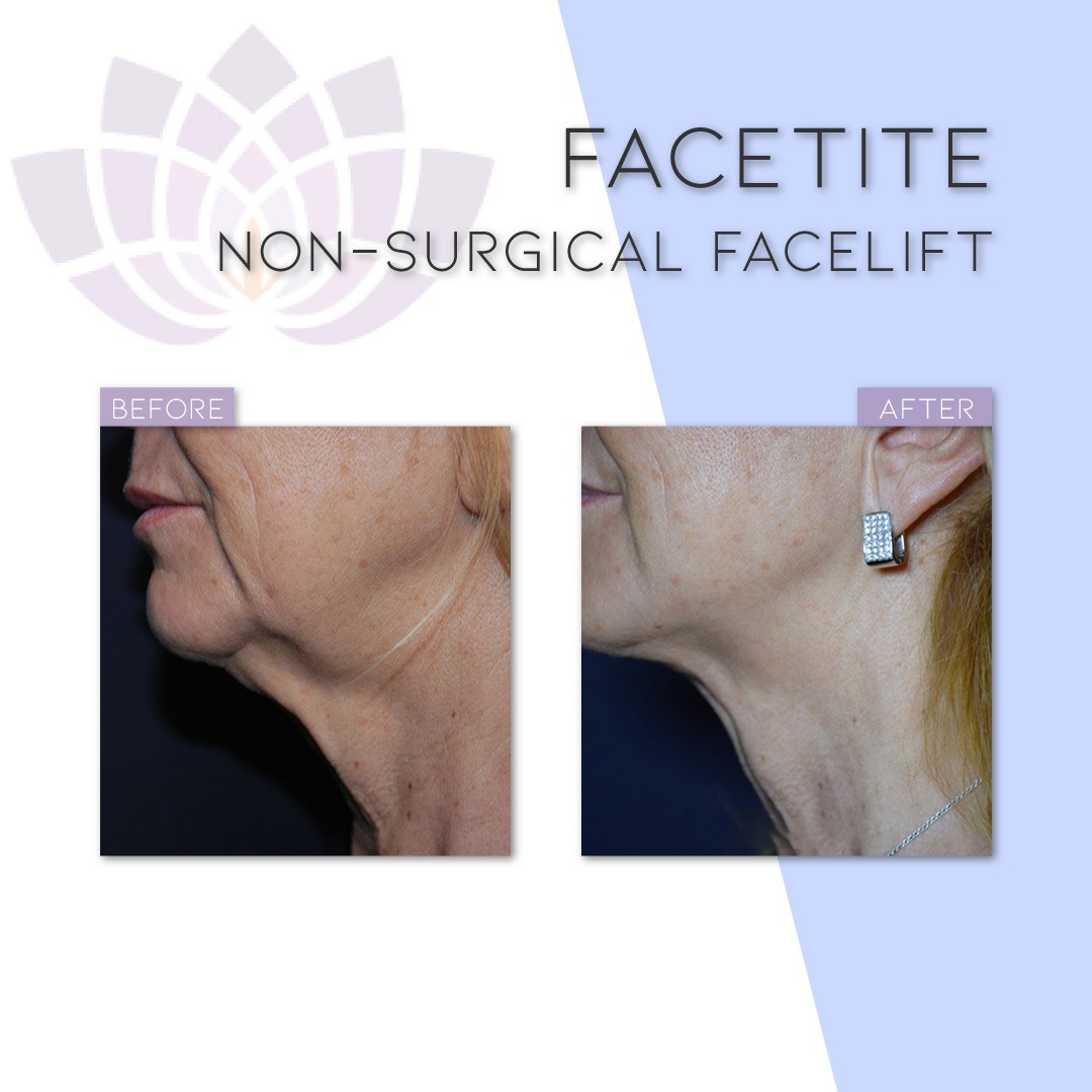 FaceTite™ is the most advanced non surgical facial contouring and skin tightening treatment available.  The treatment provides dramatic improvement in skin laxity and sagging on face and neck, with usually only one treatment needed.

#cambridgeclearbeauty #nonsurgical #cambridge #facetite #facelift #beautifulskin #antiaging