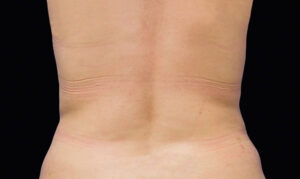 Coolsculpting on Stomach Fat Freezing Treatment Tummy Back After