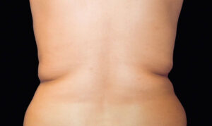 Coolsculpting on stomach Fat Freezing Treatment Tummy Back Before