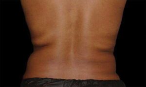 Coolsculpting on Back After Treatment