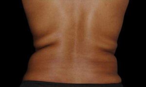 Coolsculpting on Back Before Treatment