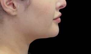 Coolsculpting on Chin After Treatment