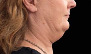 Coolsculpting on Chin & Face Before Treatment