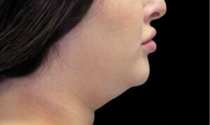 Coolsculpting on Chin Before Treatment