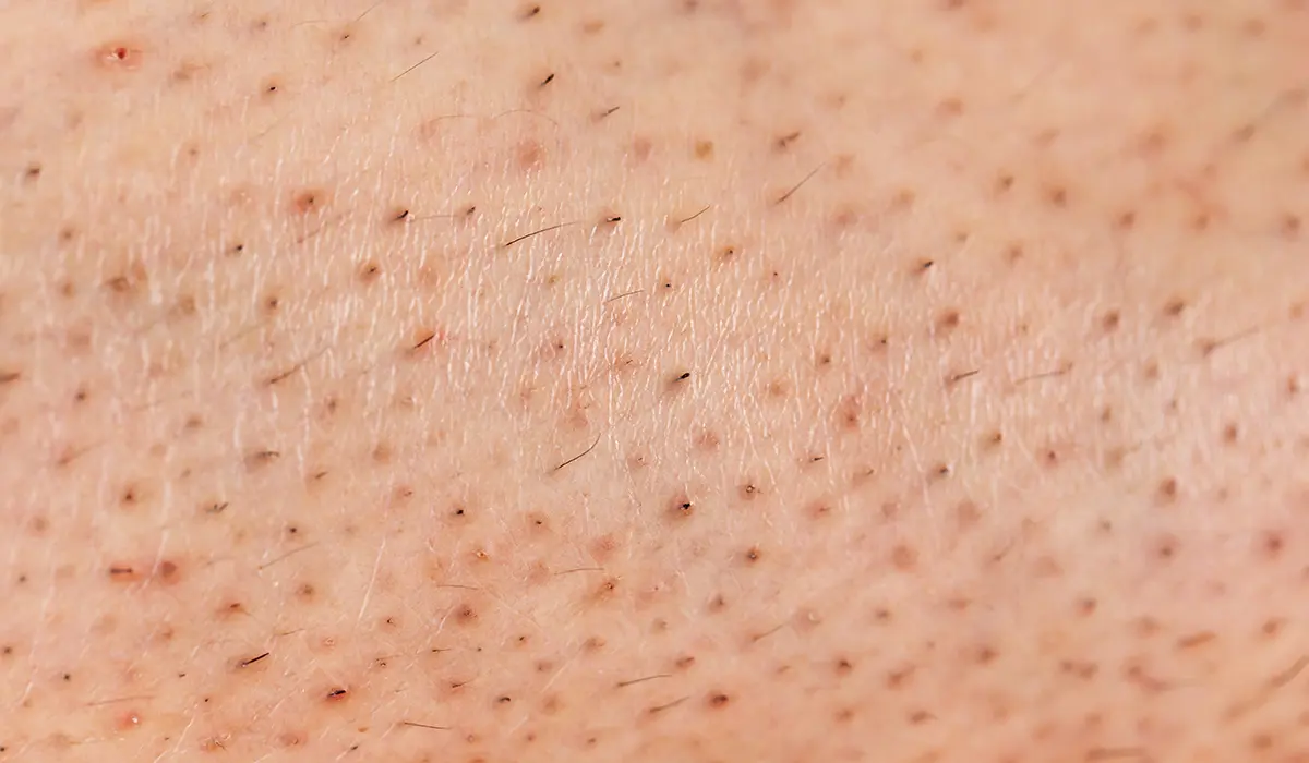 Skin-Texture - Ingrown Hairs