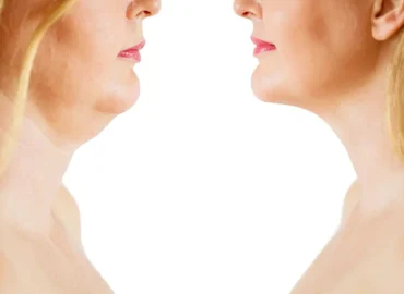 Neck Ageing - Neck Lift