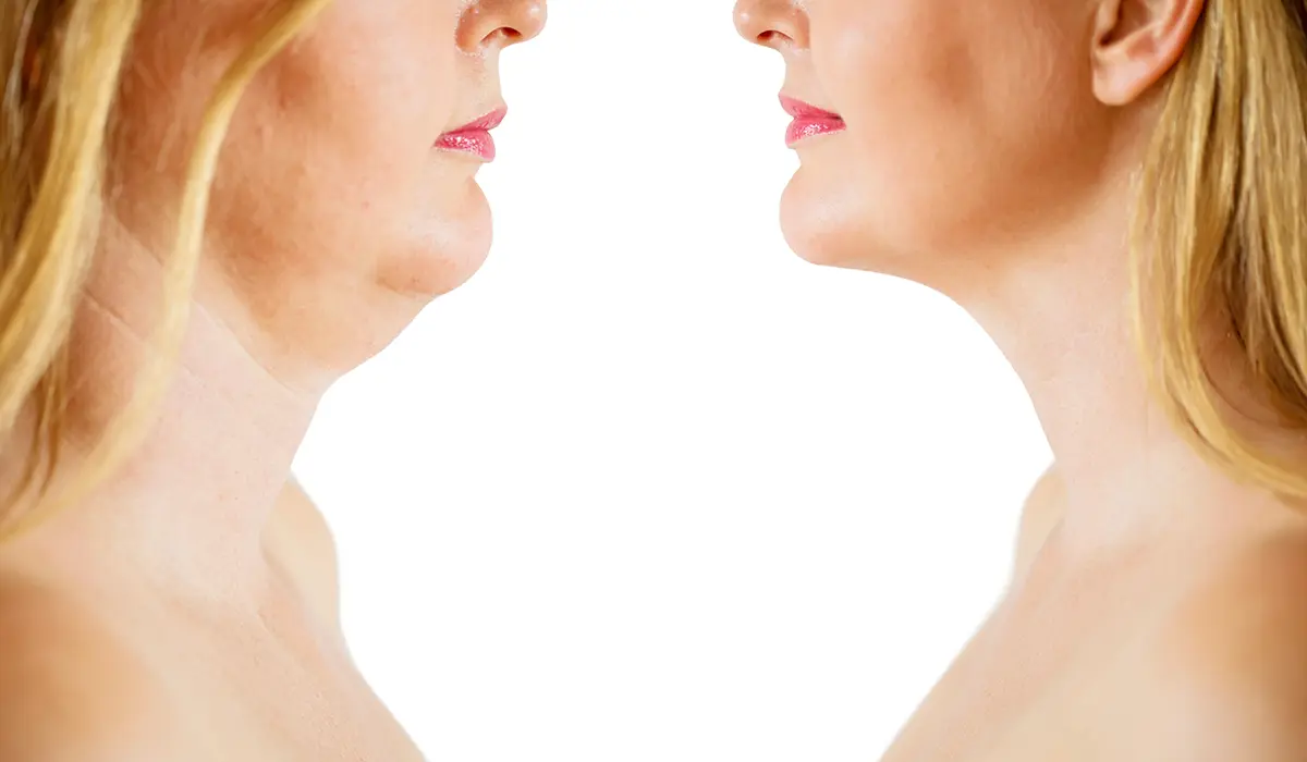 Neck Ageing - Neck Lift