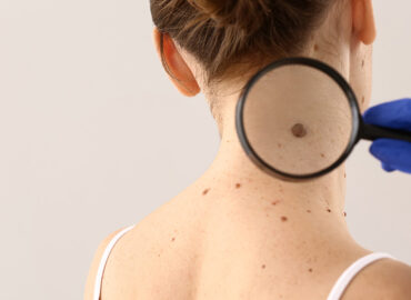 Mole Removal in Cambridge