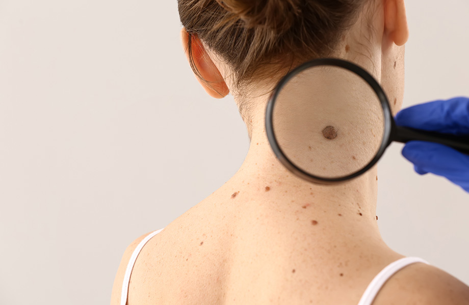 Mole Removal in Cambridge