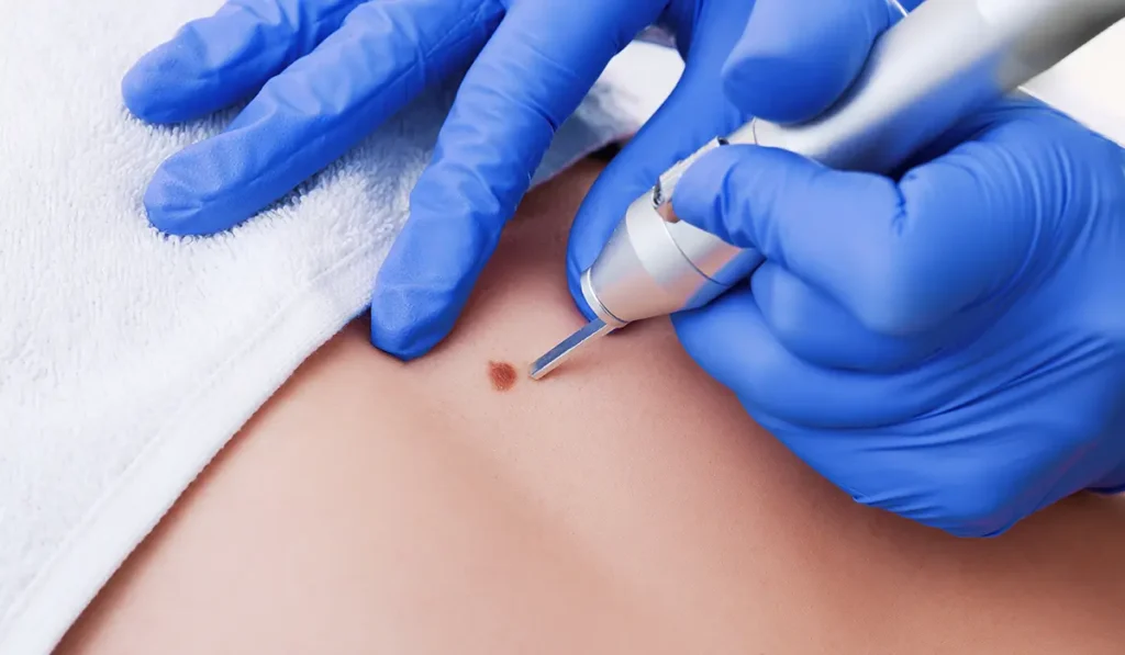 Skin Lesion Removal - Cambridge Clear Beauty