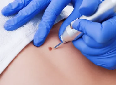 Skin Lesion Removal - Cambridge Clear Beauty