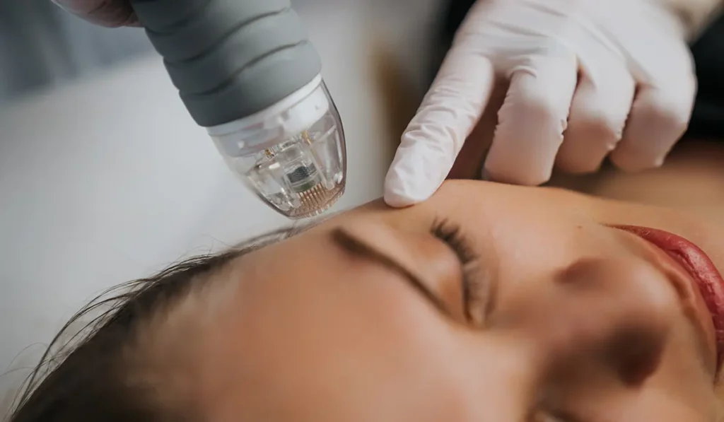 SkinPen Microneedling - Cambridge Clear Beauty