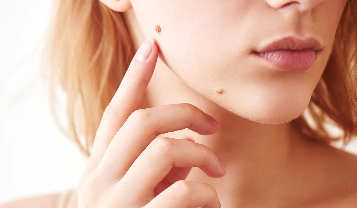 Mole Removal Treatment - Cambridge Clear Beauty