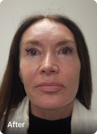 Deep Plane Facelift & Neck Lift after 1