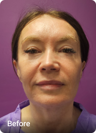 Deep Plane Facelift & Neck Lift before 1