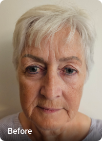 Deep Plane Facelift before