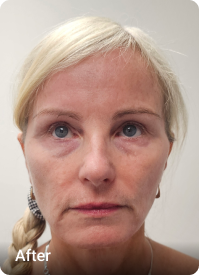 Facelift & Platysmaplasty after