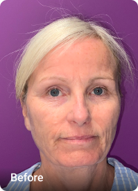 Facelift & Platysmaplasty before