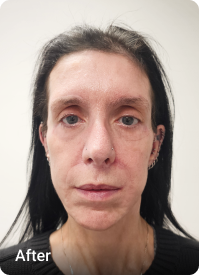 Facelift & Upper Blepharoplasty after