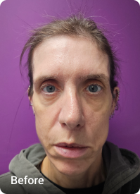 Facelift & Upper Blepharoplasty before