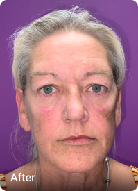 Mini Facelift before