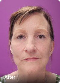 Revision Facelift after