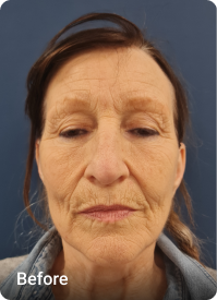 Revision Facelift before