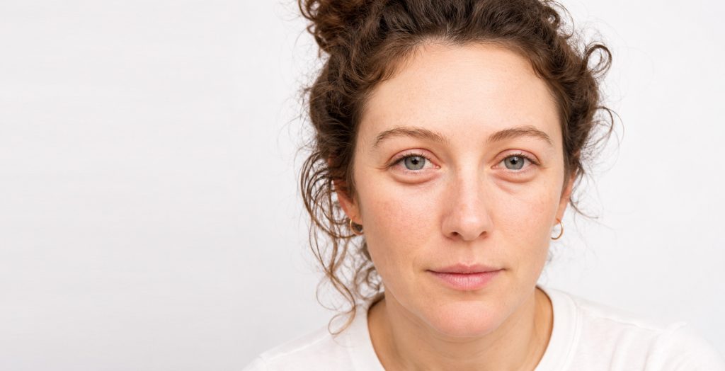 Bags Under Eyes | Bags Under Eyes Surgery | Lower Blepharoplasty