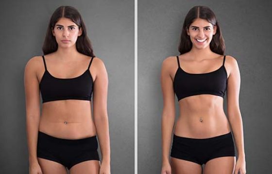 Abdominoplasty Discharge Advice
