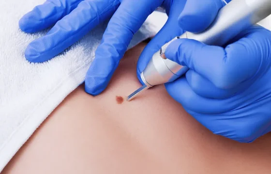 Skin Lesion Removal