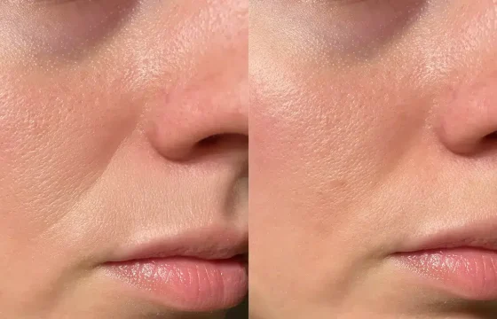 Skinpen Treatment