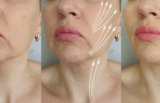 Thread Face Lifts UK