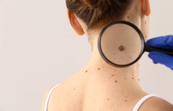 mole removal in cambridge clear beauty