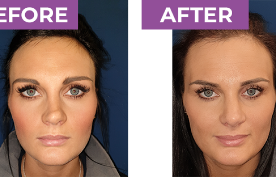rhinoplasty before after 3